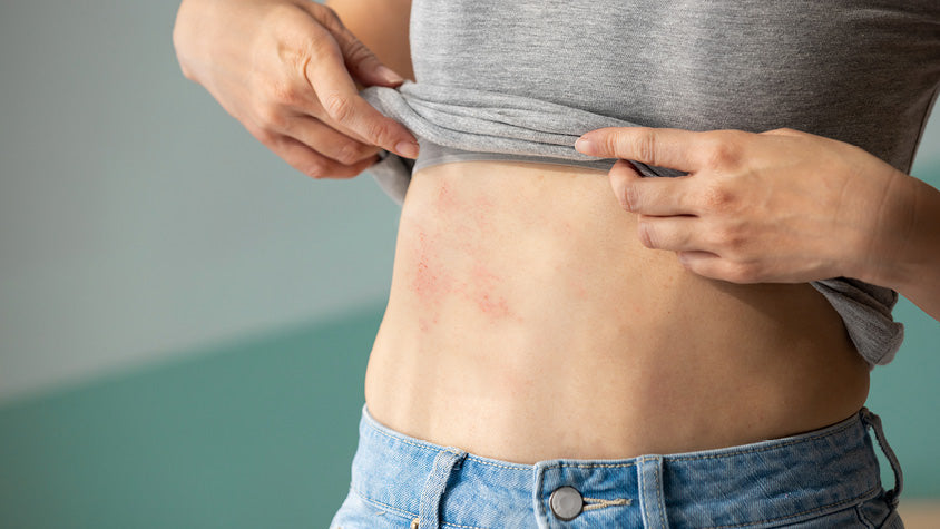 Rappresentazione dell'addome femminile con arrossamento evidenziato.